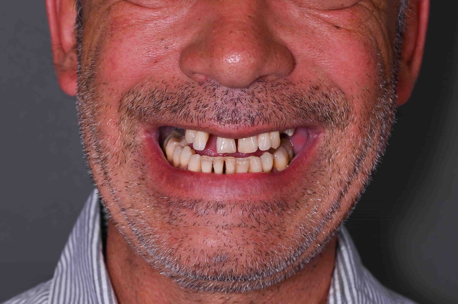Pacient Clinica Dr. Alin Odor - Rezultat Implantologie